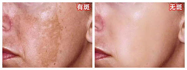 黄褐斑 - 副本.jpg
