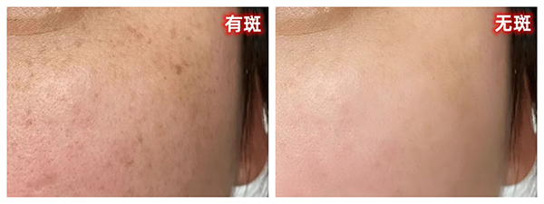 晒斑 - 副本.jpg