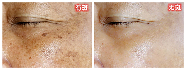 老年斑 - 副本.jpg