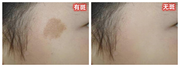 咖啡斑 - 副本.jpg